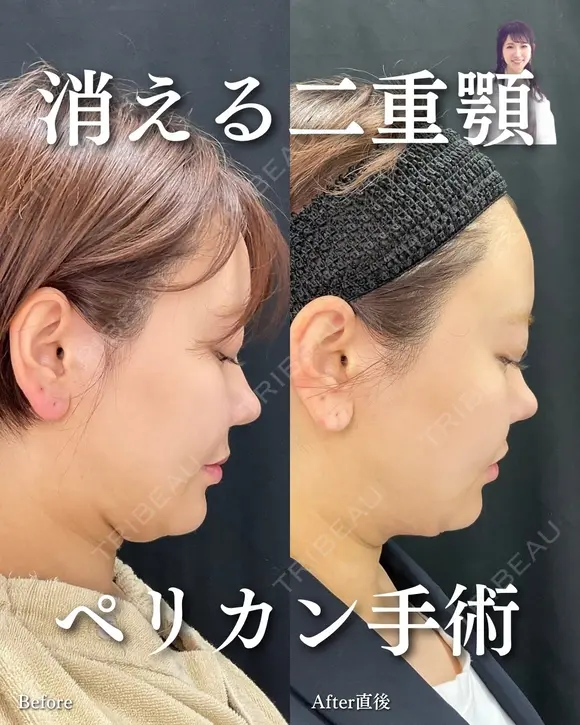 ペリカン手術 before画像 メイン用