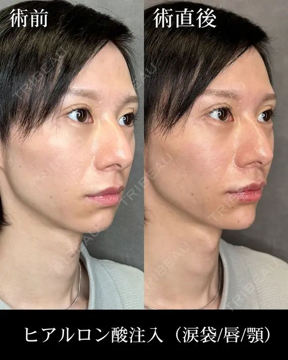 ヒアルロン酸注入（涙袋/唇/顎） after画像 メイン用