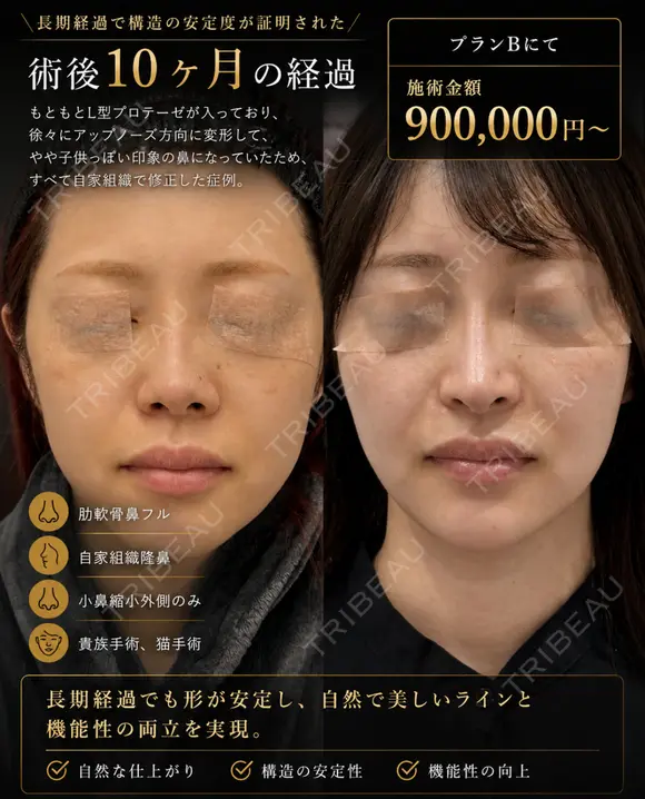 鼻フルカスタム(肋軟骨) after画像 メイン用