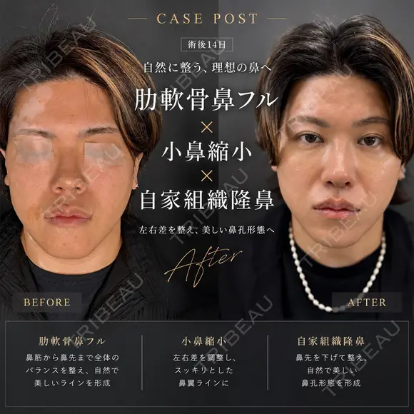 鼻フルカスタム before画像 メイン用