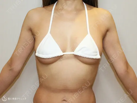 【50歳女性・柔らかく自然で綺麗なバスト】プレミアムセリューション豊胸術（3ヶ月後） 90日後 メイン用