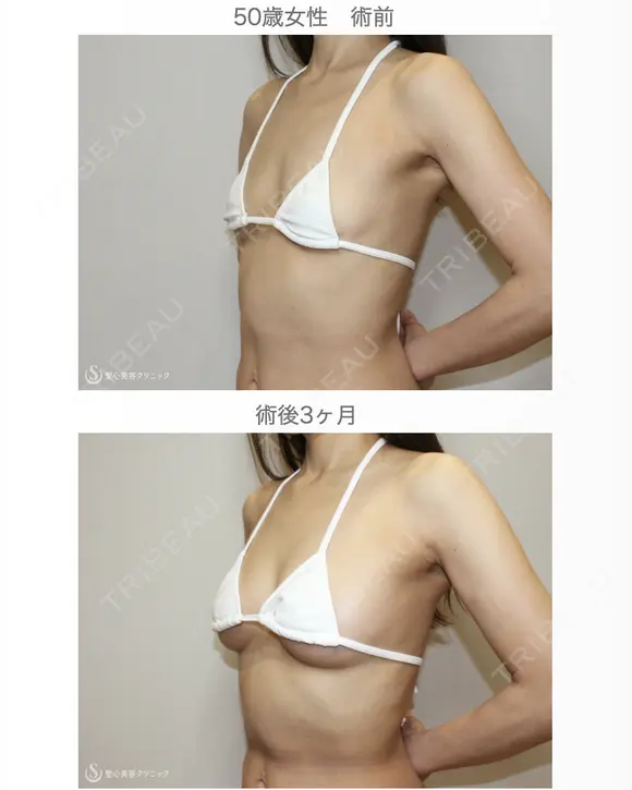 【50歳女性・柔らかく自然で綺麗なバスト】プレミアムセリューション豊胸術（3ヶ月後） 90日後 メイン用