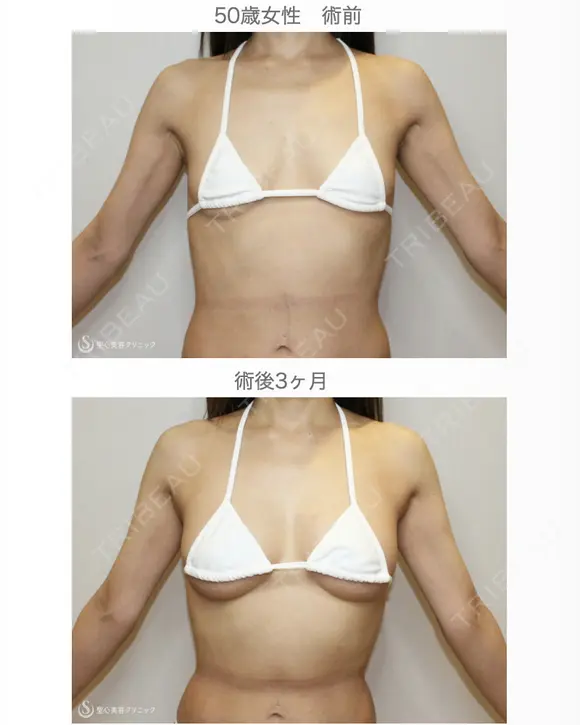 【50歳女性・柔らかく自然で綺麗なバスト】プレミアムセリューション豊胸術（3ヶ月後） 90日後 メイン用