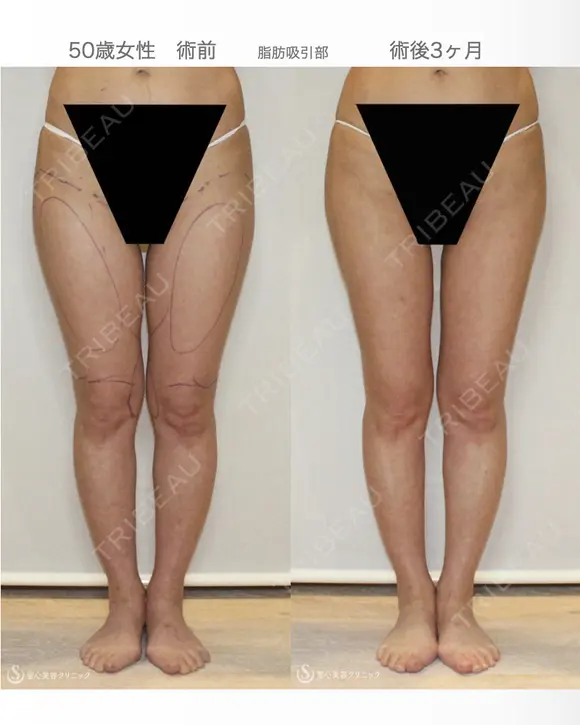 【50歳女性・柔らかく自然で綺麗なバスト】プレミアムセリューション豊胸術（3ヶ月後） 90日後 メイン用