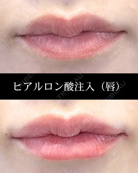ヒアルロン酸注入（唇） before画像 メイン用