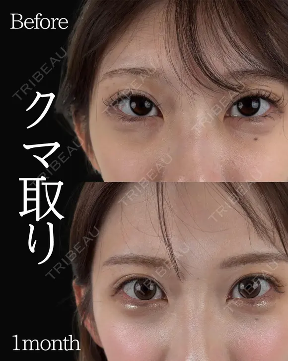 岩切医師による🔥クマ取り🔥 before画像 メイン用