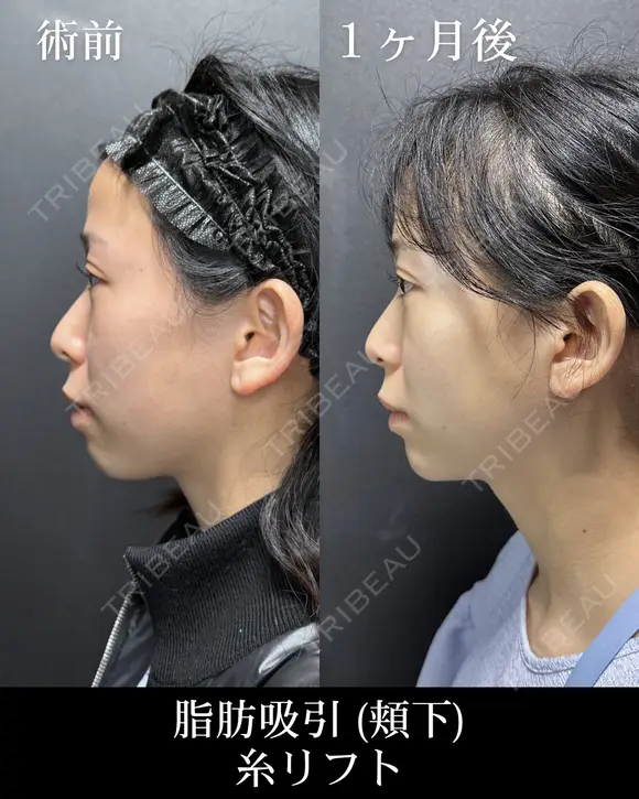 脂肪吸引 before画像 メイン用