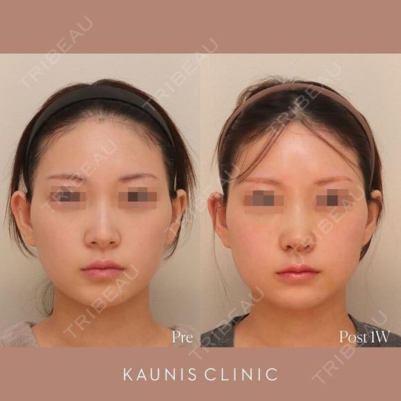 鼻中隔延長、鼻翼縮小(内側) 、鼻柱下降、鼻翼基部増大術（粉砕肋軟骨） before画像 メイン用