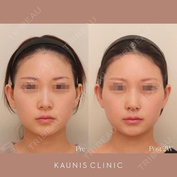 鼻中隔延長、鼻翼縮小(内側) 、鼻柱下降、鼻翼基部増大術（粉砕肋軟骨） 14日後 メイン用