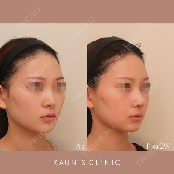 鼻中隔延長、鼻翼縮小(内側) 、鼻柱下降、鼻翼基部増大術（粉砕肋軟骨） 14日後 メイン用