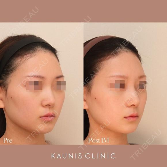 鼻中隔延長、鼻翼縮小(内側) 、鼻柱下降、鼻翼基部増大術（粉砕肋軟骨） 30日後 メイン用