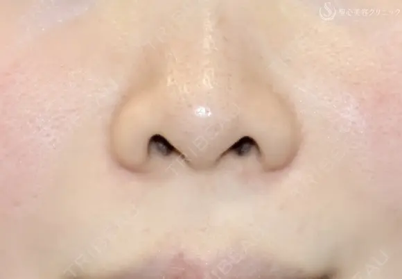 【30代女性・鼻の穴が見えるのが気になる】鼻孔縁下降術（1ヶ月後） before画像 メイン用