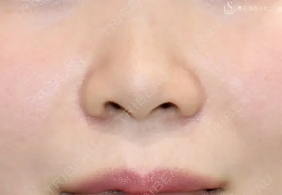【30代女性・鼻の穴が見えるのが気になる】鼻孔縁下降術（1ヶ月後） 30日後 メイン用