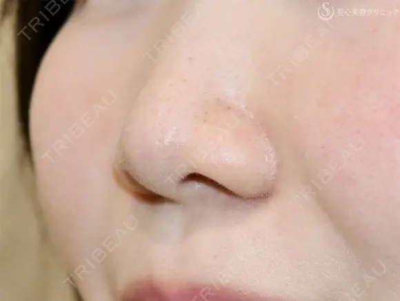 【30代女性・鼻の穴が見えるのが気になる】鼻孔縁下降術（1ヶ月後） 30日後 メイン用