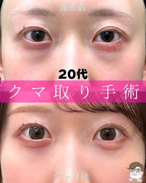目の下のふくらみ取り・脂肪注入（目の下・ゴルゴライン） before画像 メイン用