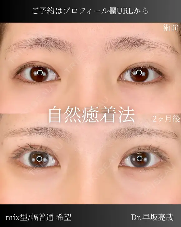 自然癒着法（エターナル二重術） after画像 メイン用