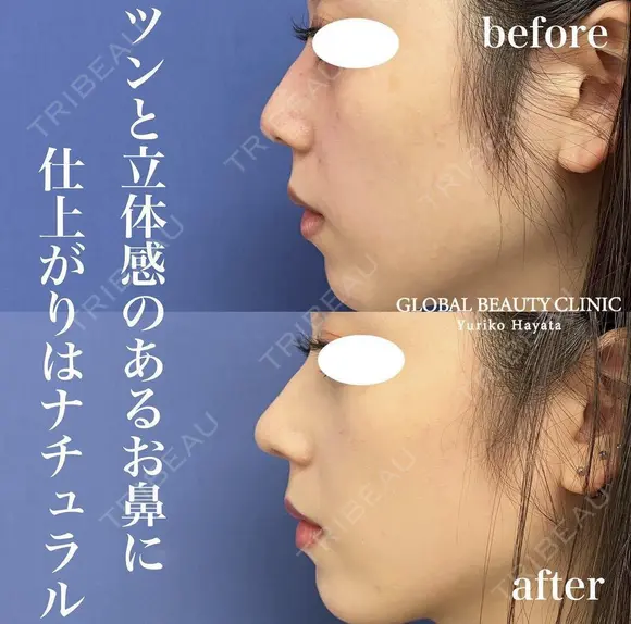 鼻複合オペ〜鼻尖形成3D(closed法)・耳珠軟骨移植 術後3ヶ月 after画像 メイン用