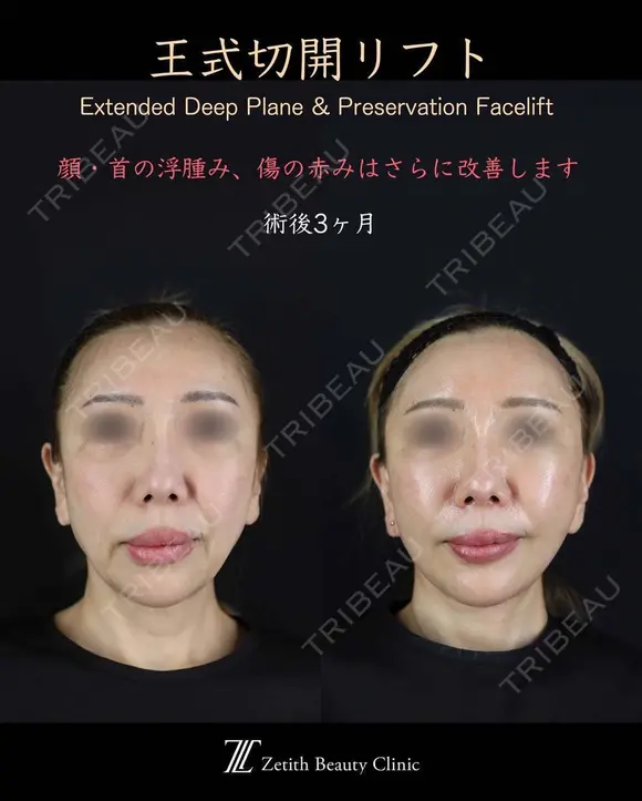 王式切開リフト before画像 メイン用