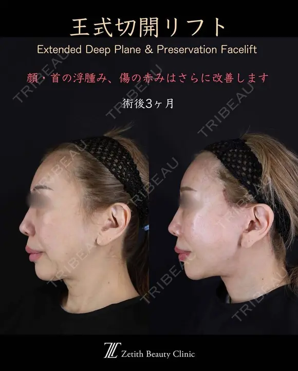 王式切開リフト 90日後 メイン用
