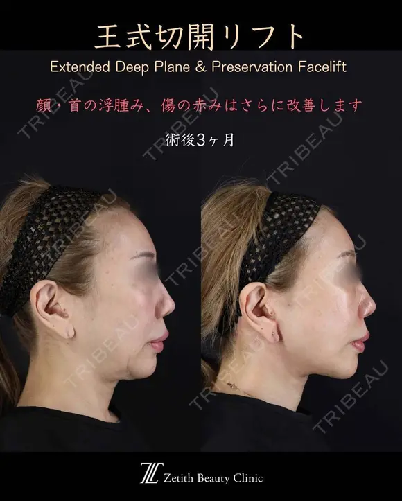 王式切開リフト 90日後 メイン用