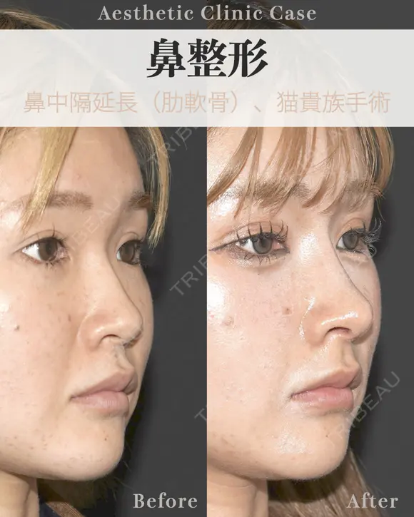 鼻中隔延長（肋軟骨）　猫貴族手術 after画像 メイン用