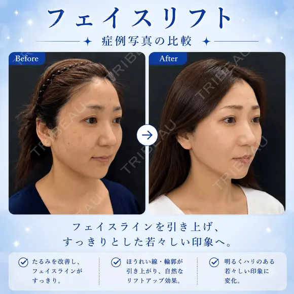 フェイスリフト after画像 メイン用