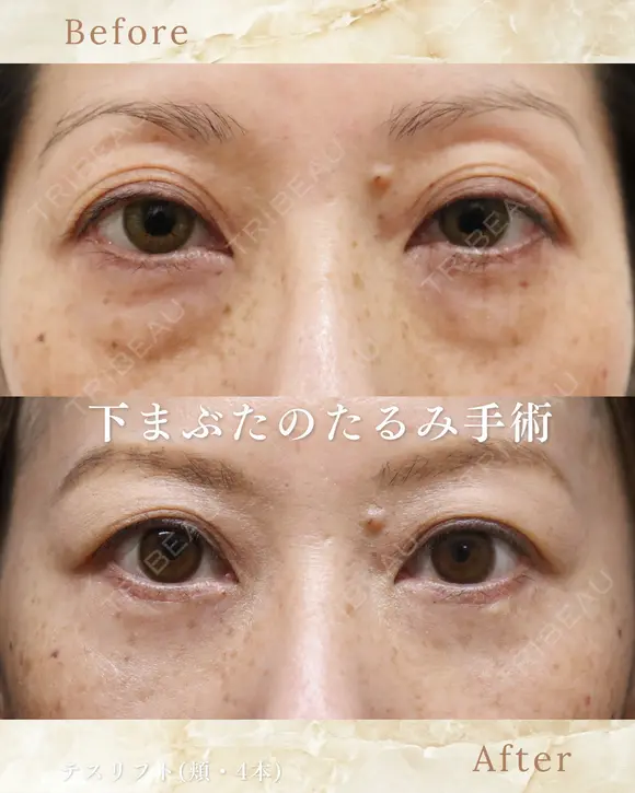 下まぶたのたるみ取り before画像 メイン用