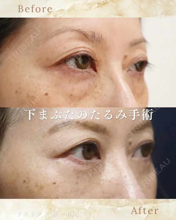 下まぶたのたるみ取り after画像 メイン用