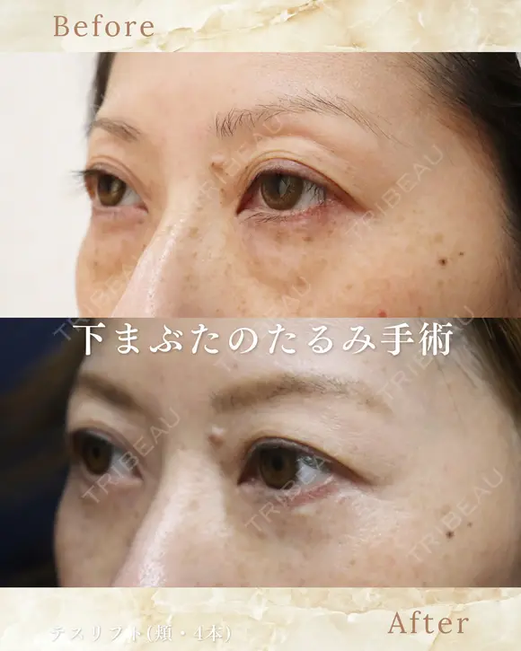 下まぶたのたるみ取り after画像 メイン用