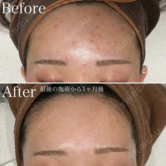 アクネスニードル before画像 メイン用