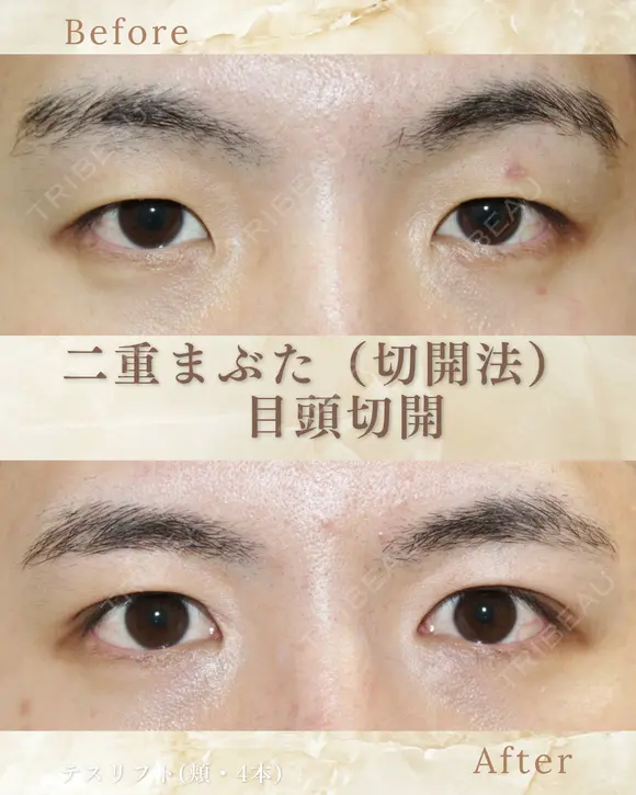二重まぶた 切開法　目頭切開 after画像 メイン用