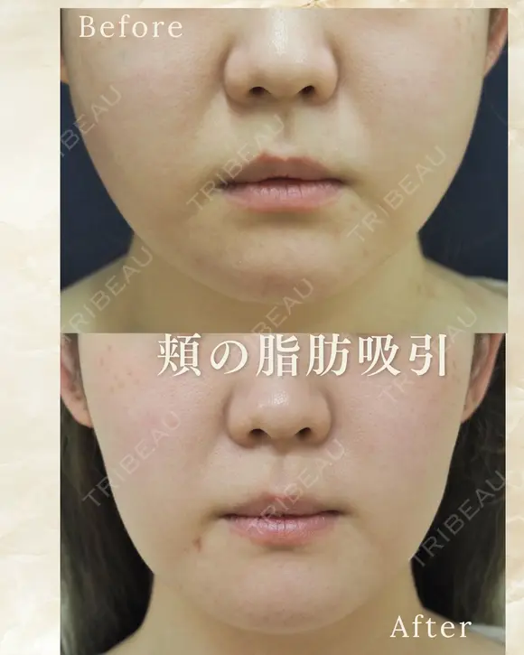 頬の脂肪吸引 before画像 メイン用