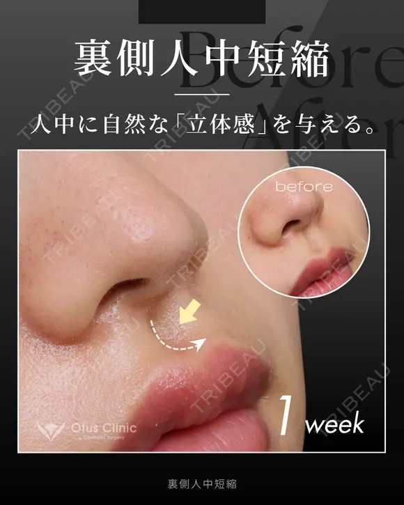 裏側人中短縮 7日後 メイン用
