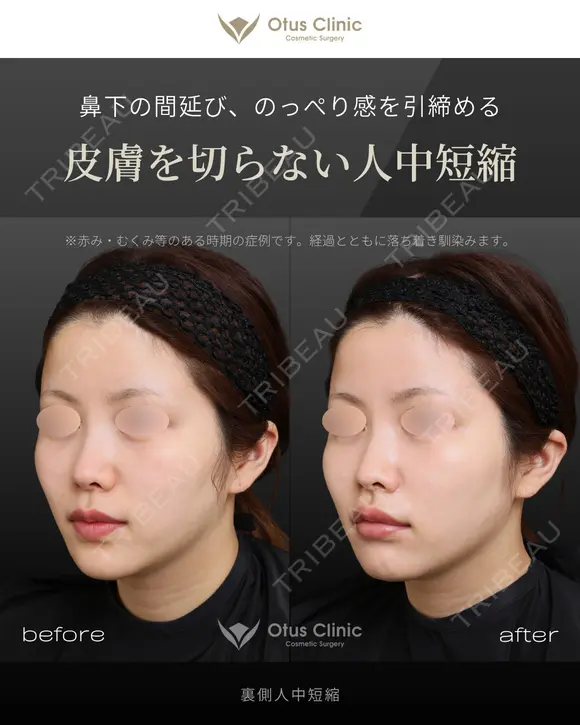 裏側人中短縮 before画像 メイン用