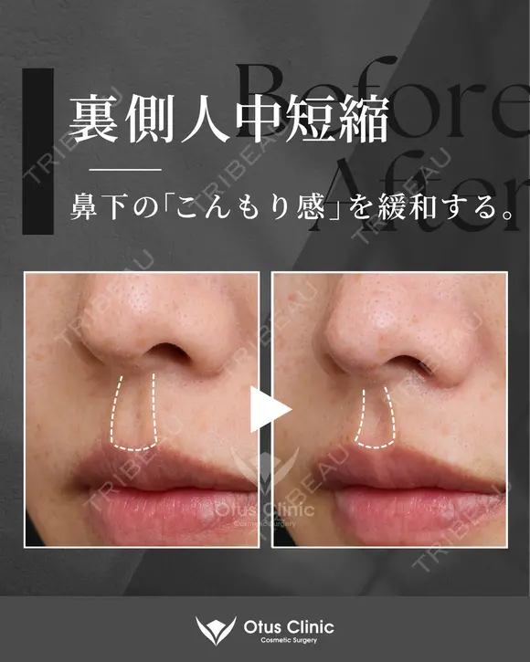 裏側人中短縮 7日後 メイン用
