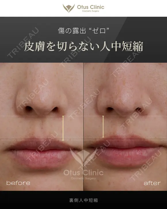 裏側人中短縮 before画像 メイン用