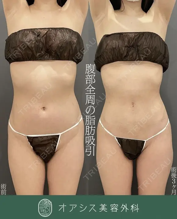 シリンジ法で細やか丁寧に吸引🌴コンプリート脂肪吸引【上下腹部・ウエスト・腰】形成外科専門医がご対応 after画像 メイン用