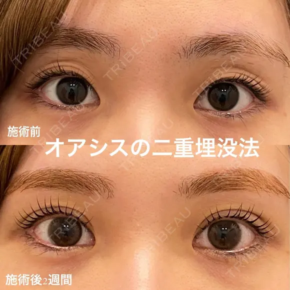 自然にぱっちり👀オアシスの【二重埋没法】形成外科専門医がご対応🌴瞼板法 after画像 メイン用