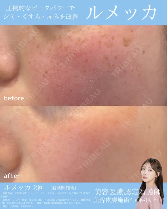 しみ・そばかすに✨ルメッカ before画像 メイン用