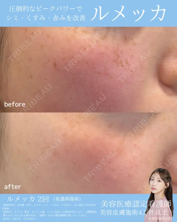 しみ・そばかすに✨ルメッカ after画像 メイン用