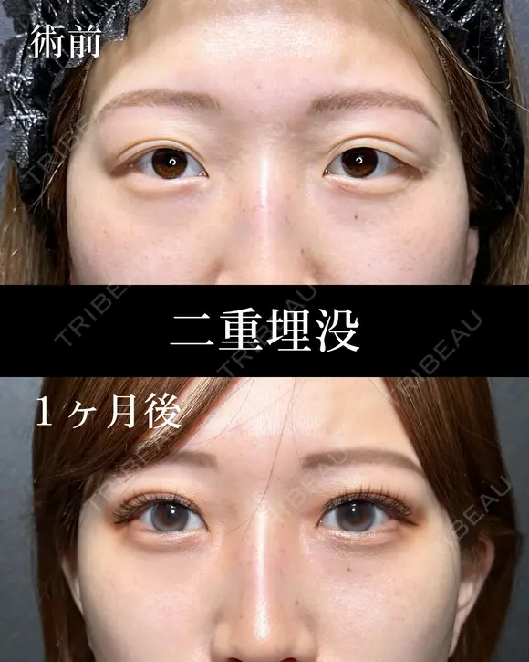 二重埋没 before画像 メイン用