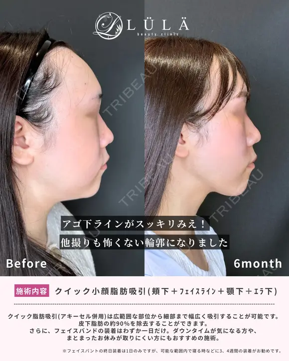 クイック小顔脂肪吸引（頬下+フェイスライン+顎下+エラ下） after画像 メイン用