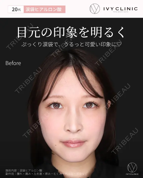 涙袋ヒアルロン酸 before画像 メイン用