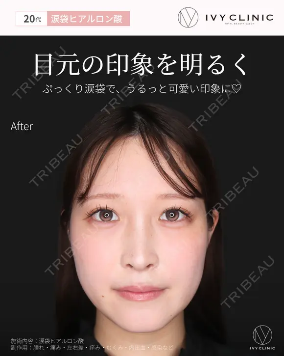 涙袋ヒアルロン酸 0日後 メイン用
