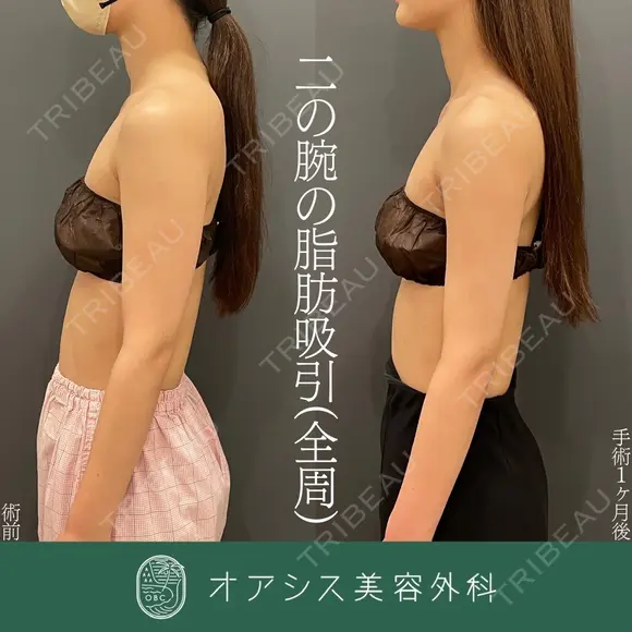 シリンジ法🌴コンプリート脂肪吸引【上腕全周～お背中一部】形成外科専門医がご対応 before画像 メイン用