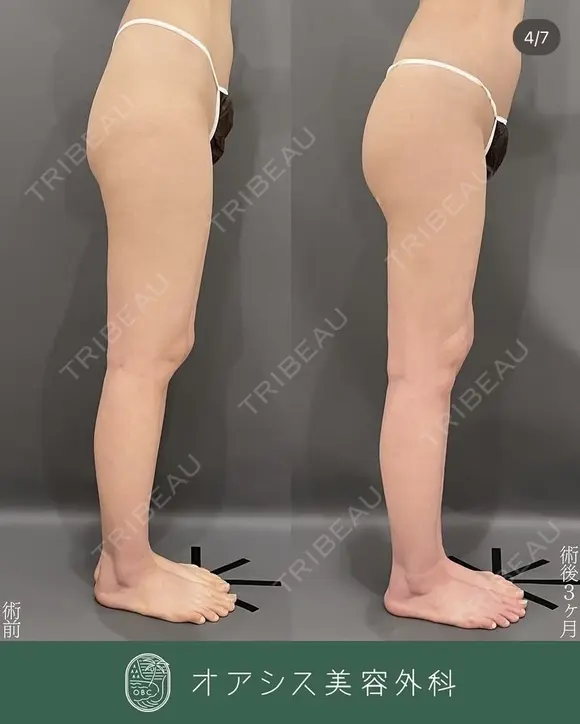 形成外科専門医がご対応🌴コンプリート脂肪吸引【大腿全周臀部一部含む】シリンジ法 before画像 メイン用