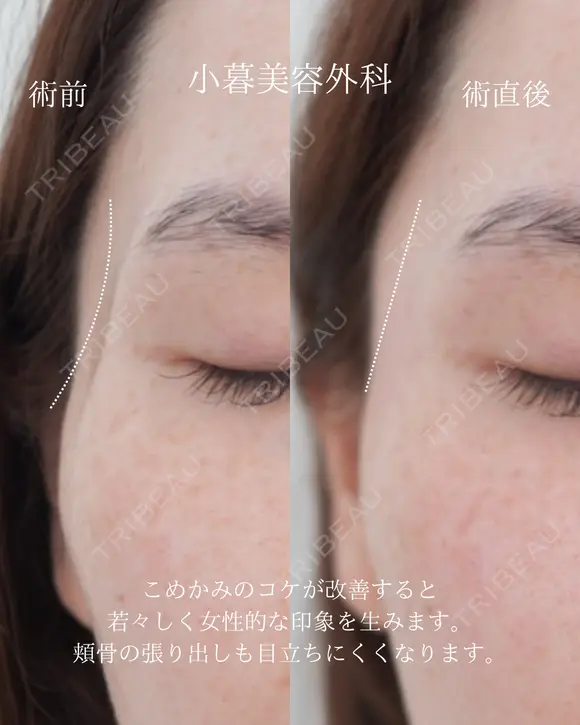 こめかみヒアルロン酸 before画像 メイン用