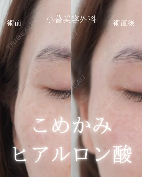 こめかみヒアルロン酸 0日後 メイン用