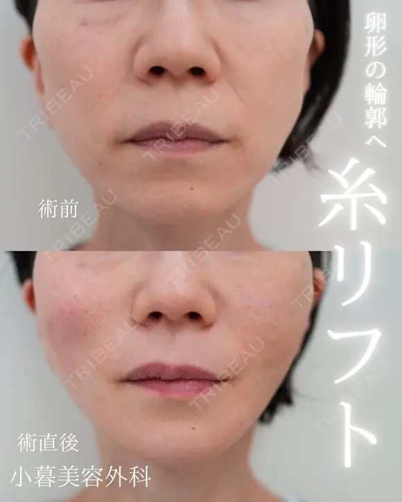 糸リフト 0日後 メイン用