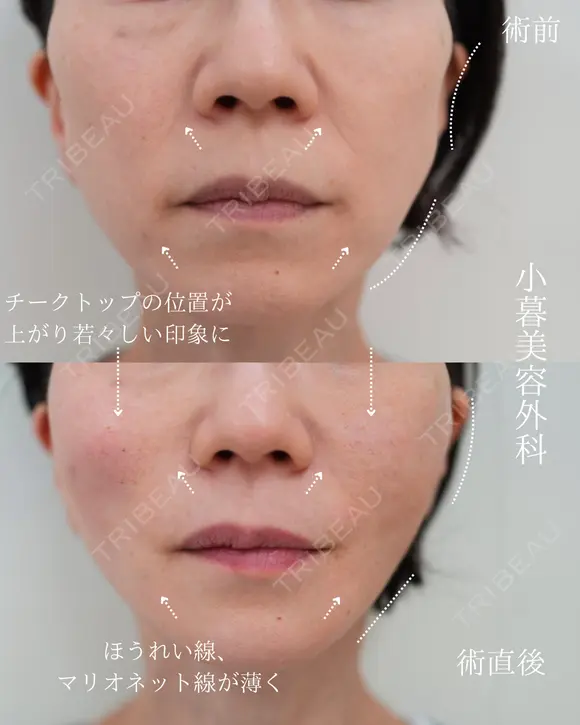 糸リフト before画像 メイン用
